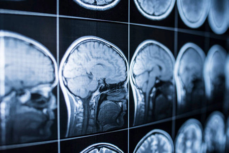 Vacuna ARNm contra el cáncer y tumores cerebrales